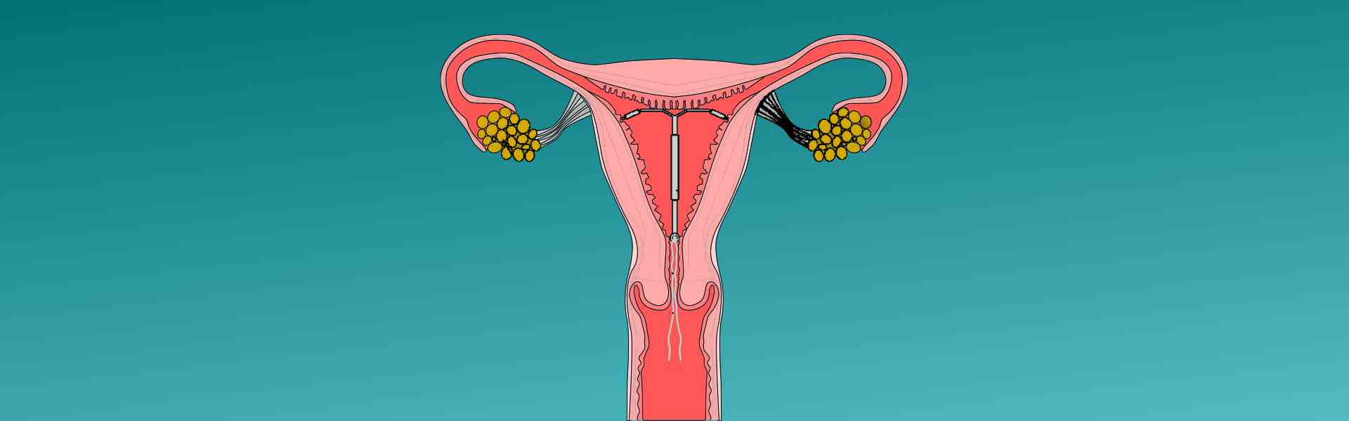 Best IUD Insertions in Baner, Pune