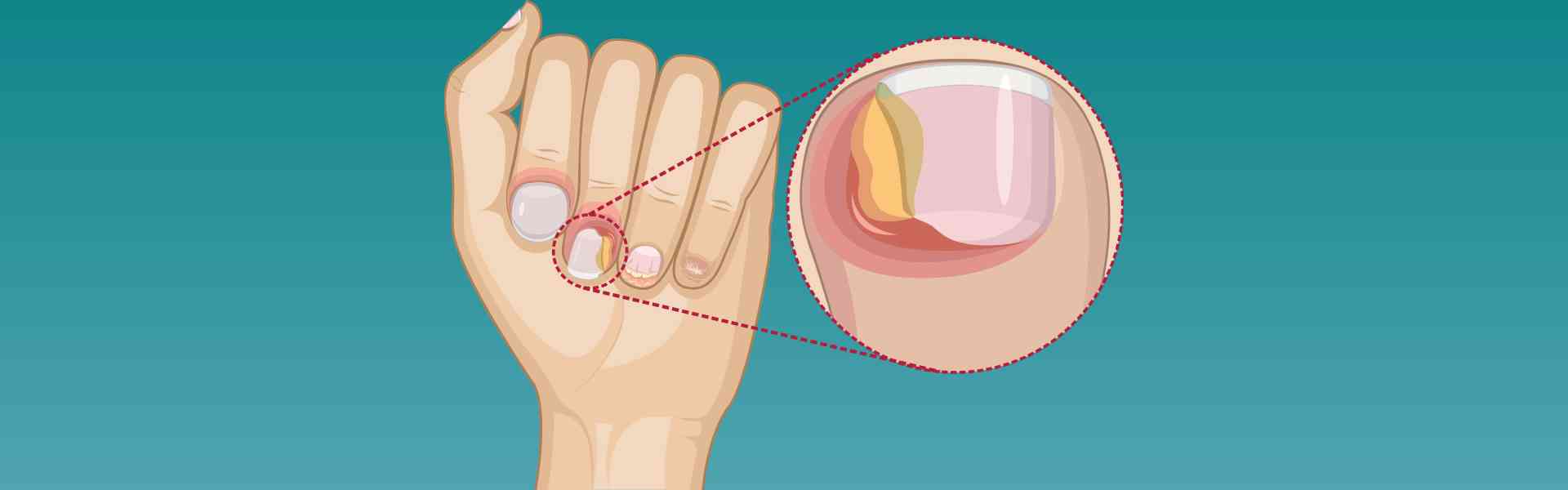 Paronychia Nail Infection Treatment in Pune