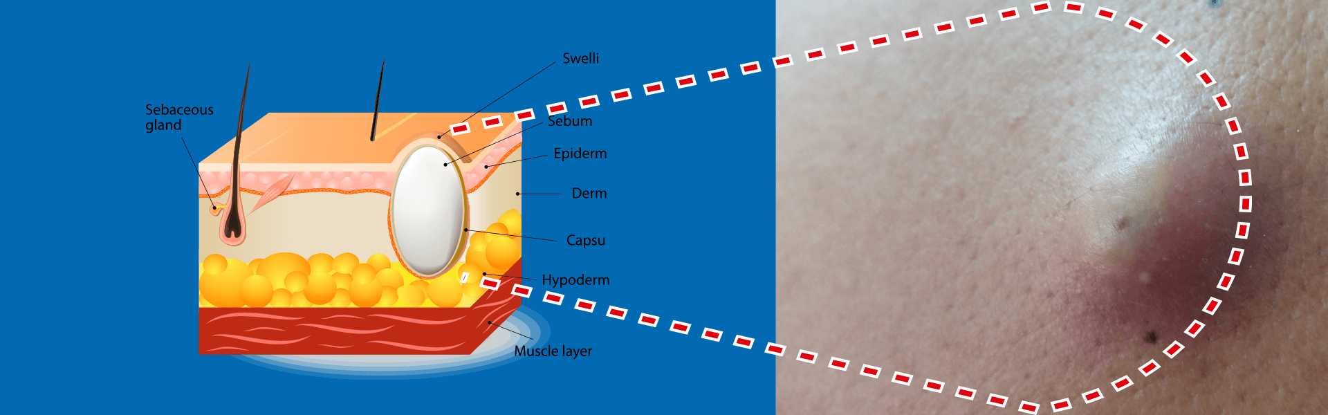 Sebaceous Cysts Treatment Procedure in Baner, Pune