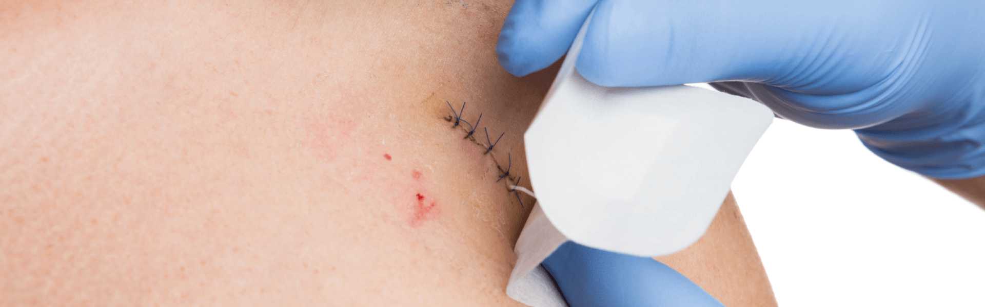Suture Removal in Baner, Pune