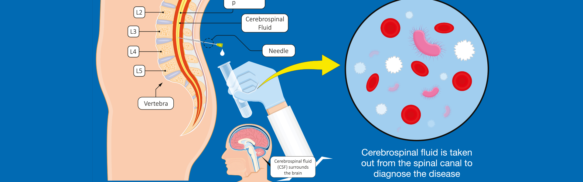 Top Neurology Clinic in Jayanagar | Lumbar Puncture Treatment in Jayanagar - Manipal Hospital