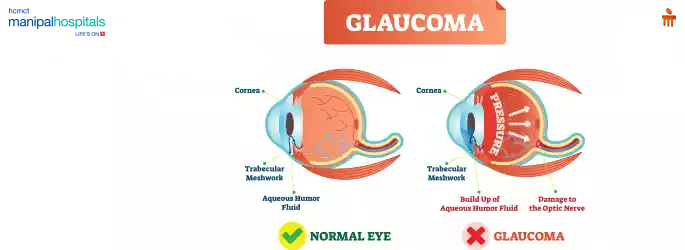 glaucoma treatment in Delhi