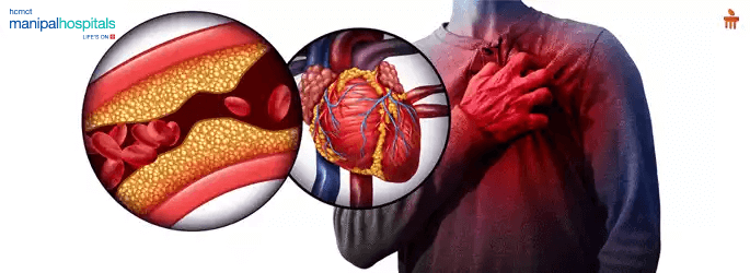 cardiothoracic surgery in Delhi