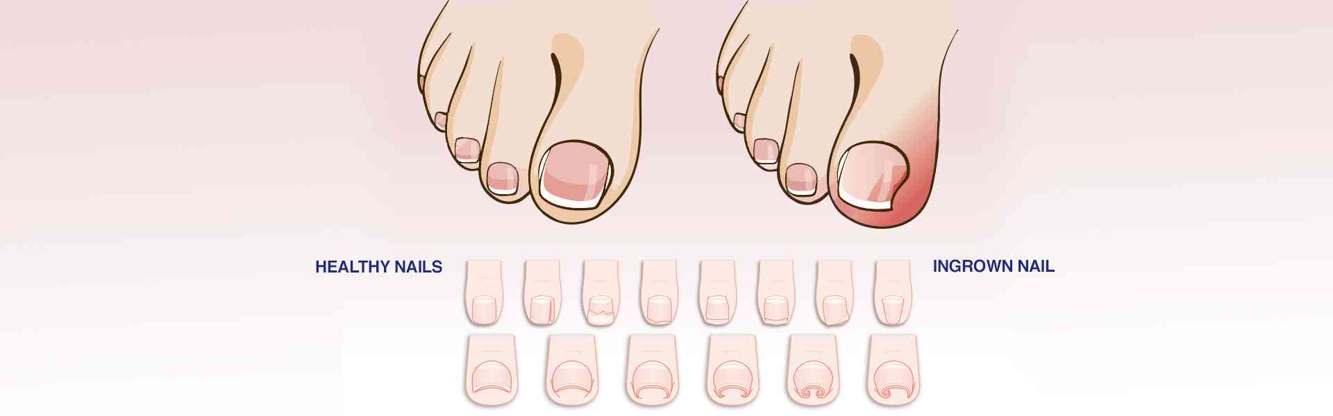 Ingrown Nail Removal Hospital in Delhi