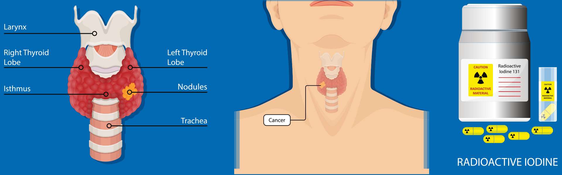 Iodine 131 Therapy For Thyroid Cancer in Delhi