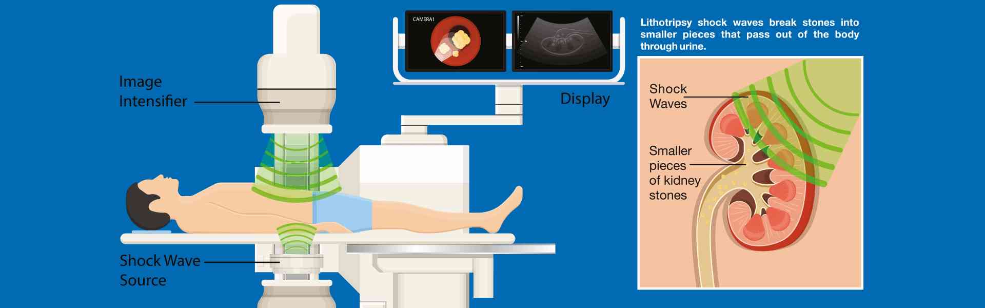 Lithotripsy Treatment in Delhi