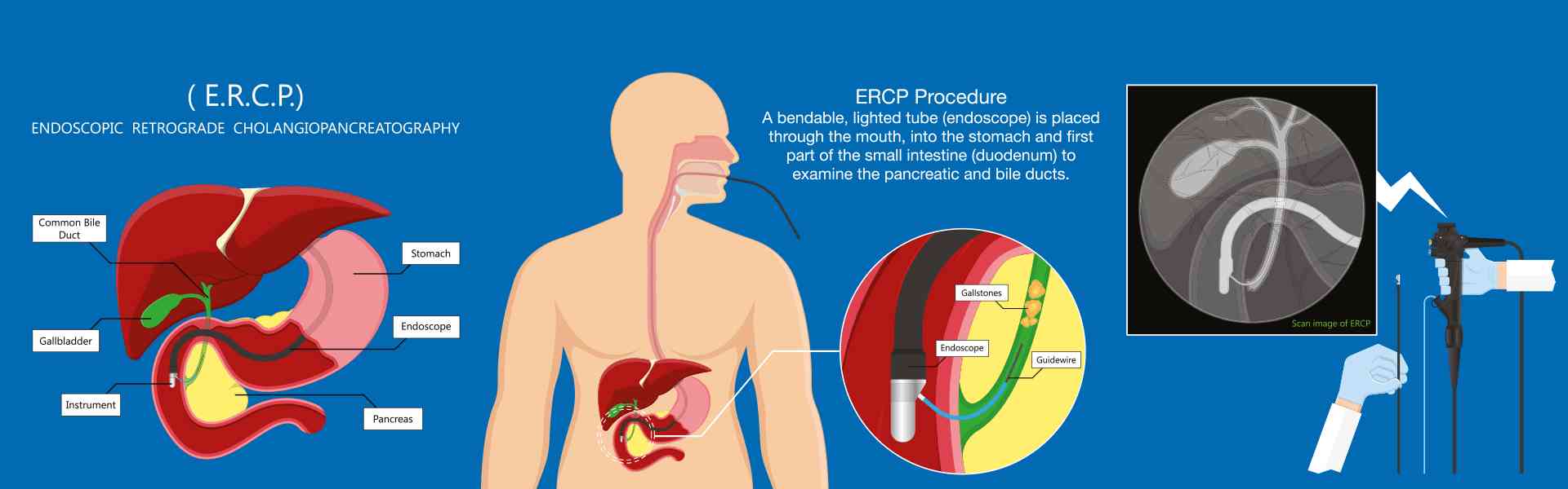 ERCP Diagnostic Test in Old Airport Road