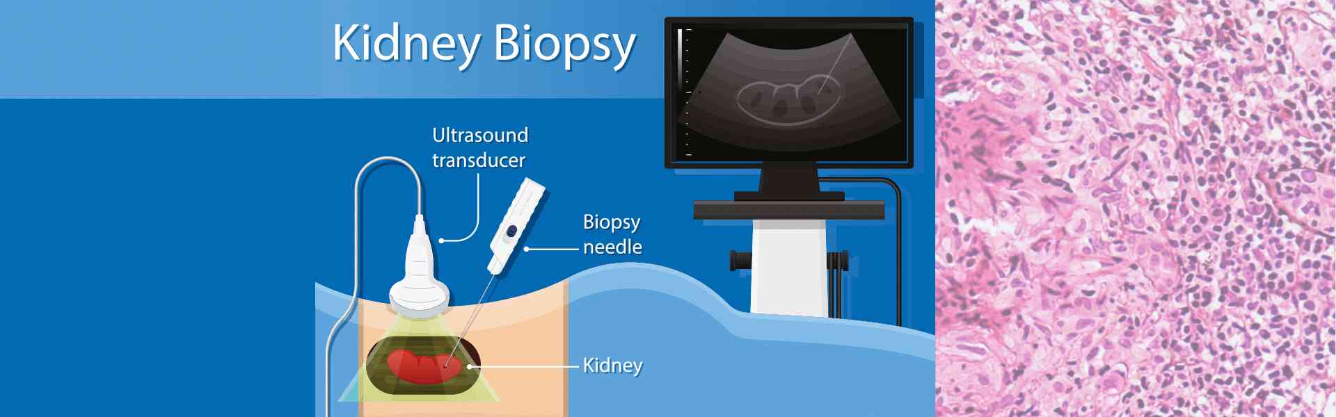 Kidney Biopsy Treatment in Old Airport Road