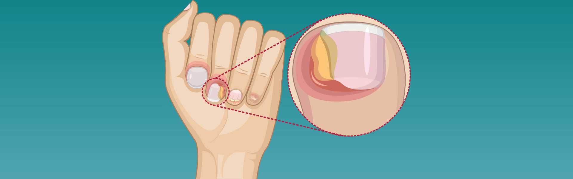 Paronychia Nail Infection Treatment Hospital in Bangalore