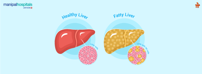 Alcohol Related Liver Disease