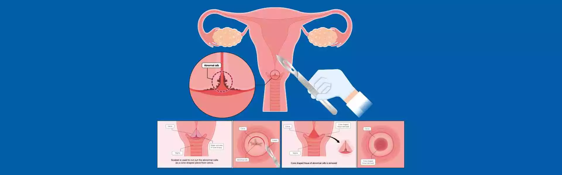 Pap Smear, HPV Test And Colposcopy in Ghaziabad