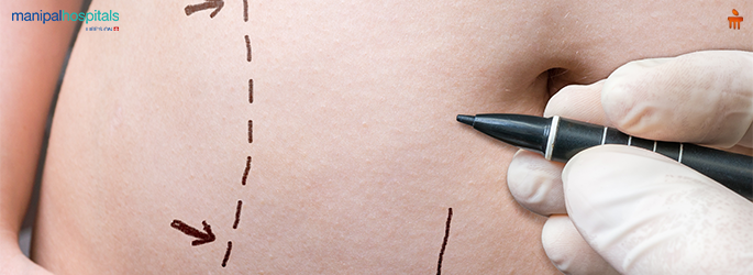 Bariatric Surgery in Goa