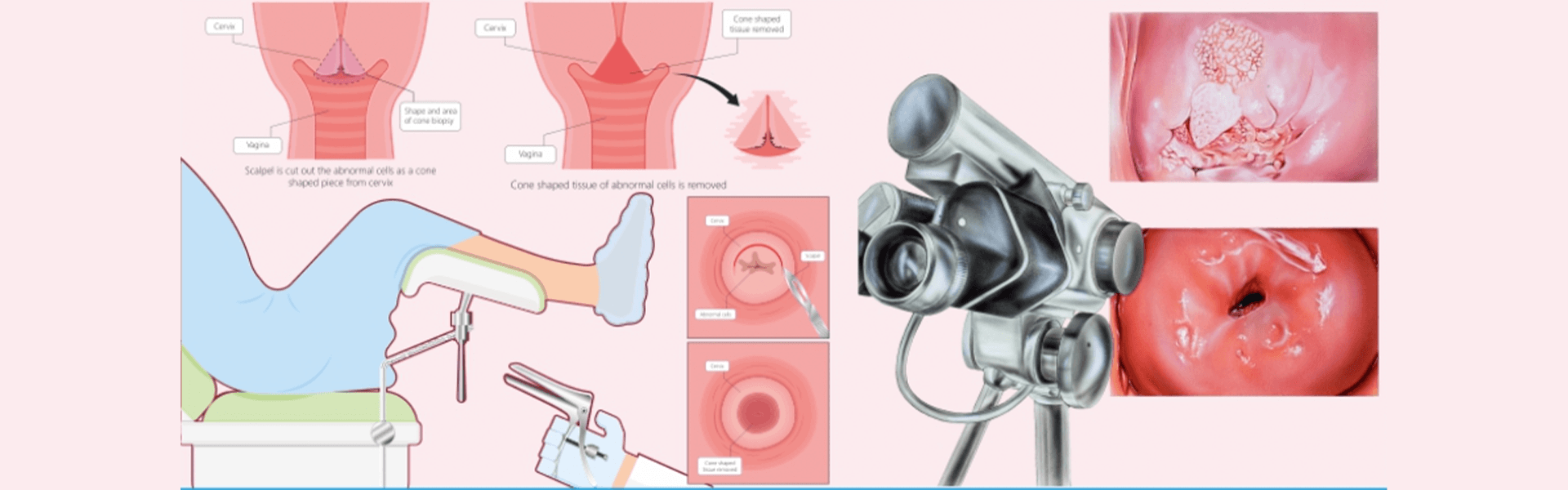 Colposcopy Procedure in Goa | Colposcopy Clinic - Manipal Hospitals