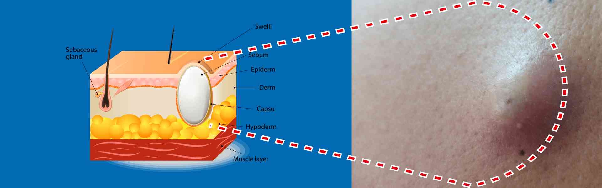 Sebaceous Cysts Surgery in Goa