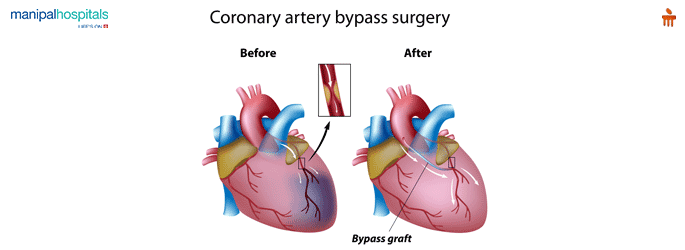 Best Cardiothoracic Vascular Surgeons in Gurgaon