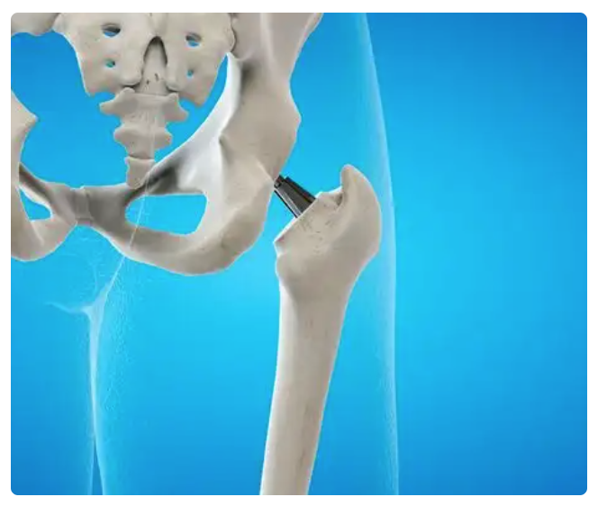 Total hip replacement revolutionises recovery at Gurugram hospital