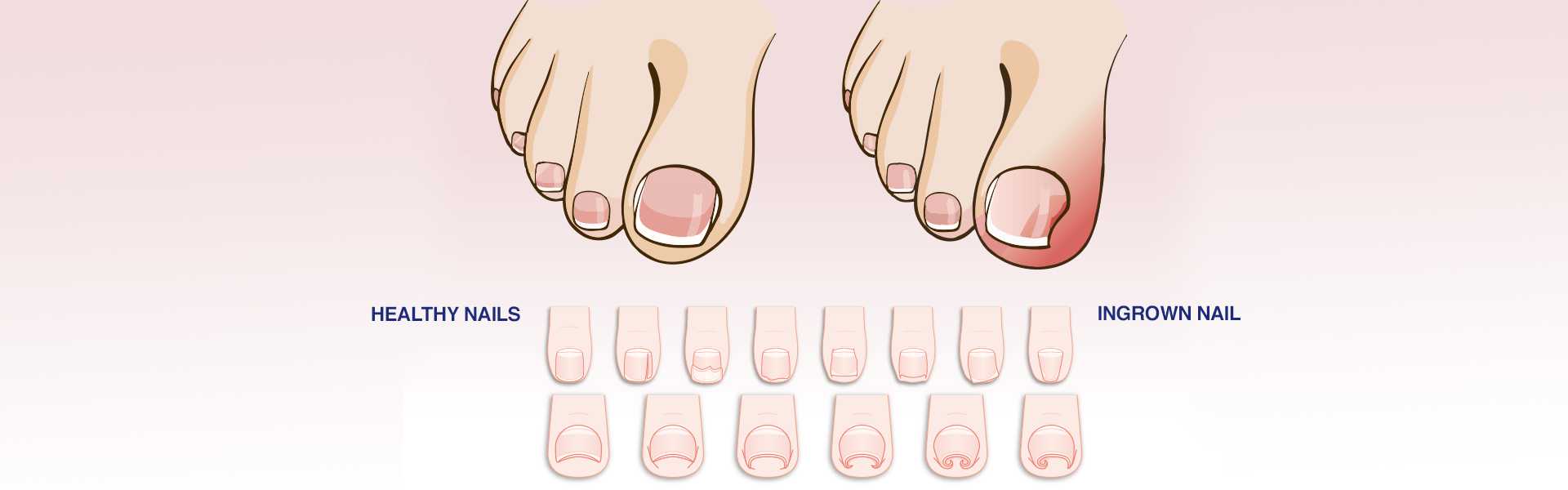 Ingrown Toe Nail Treatment in Gurugram