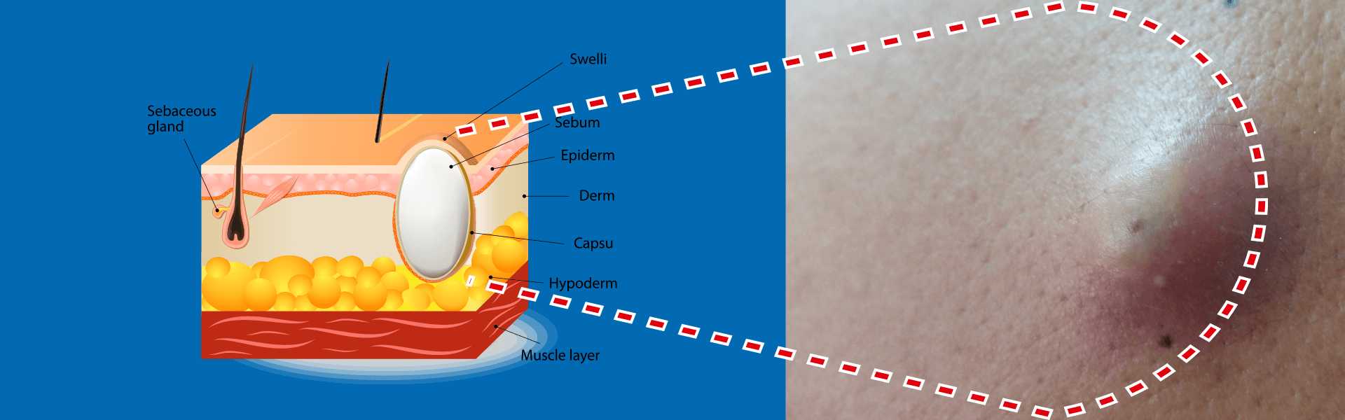 Sebaceous Cysts Treatment in Gurugram