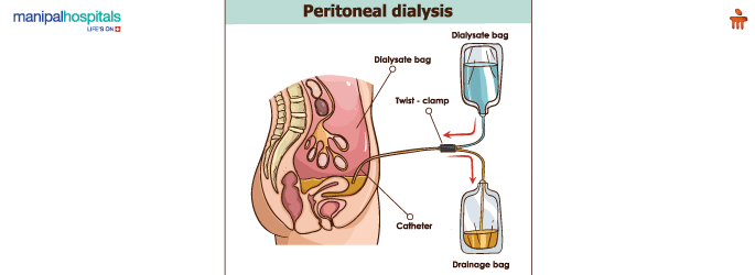 Peritoneal Dialysis Treatment in Hebbal