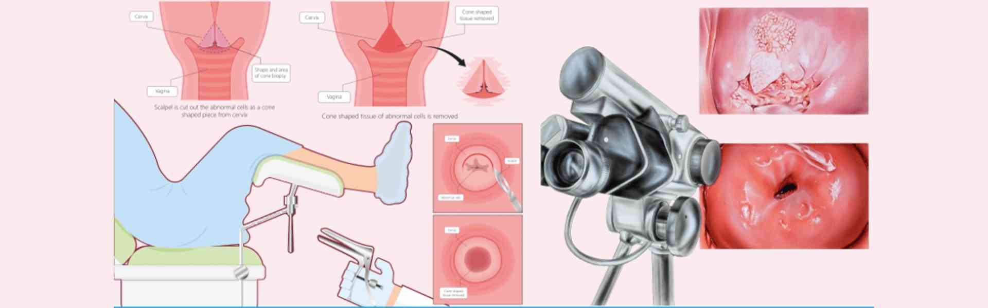 Colposcopy Examination Centres in Old Airport Road