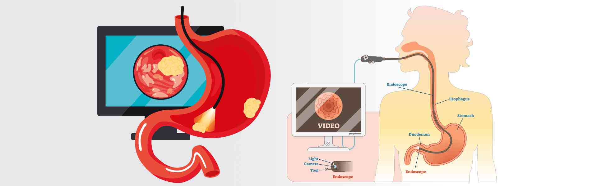 OGD - Oesophago-gastro Duodenoscopy treatment