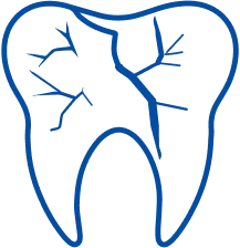 root canal treatment in jaipur