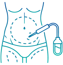 Advanced Liposuction Surgery in Jaipur | Manipal Hospitals