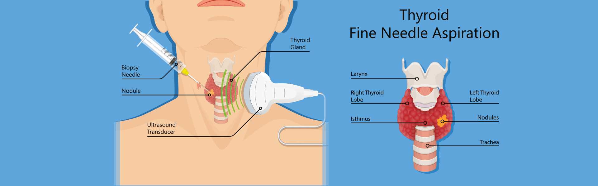 Fine Needle Aspiration Cytology Procedure in Jaipur