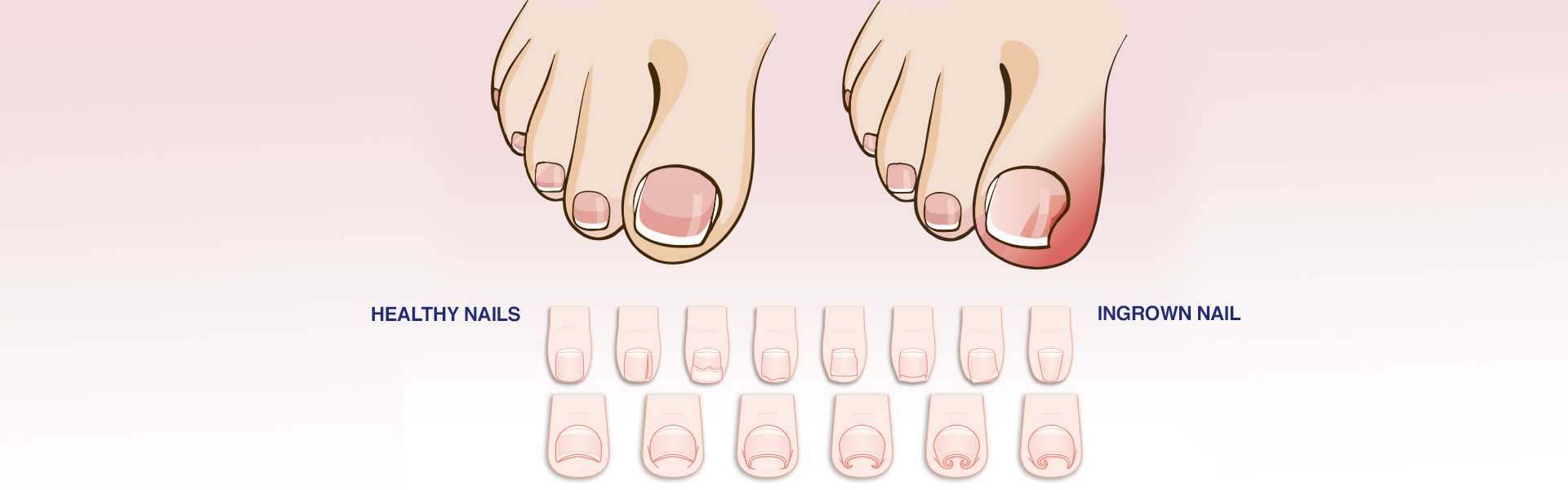 Ingrown Toe Nail Treatment Hospital in Jaipur