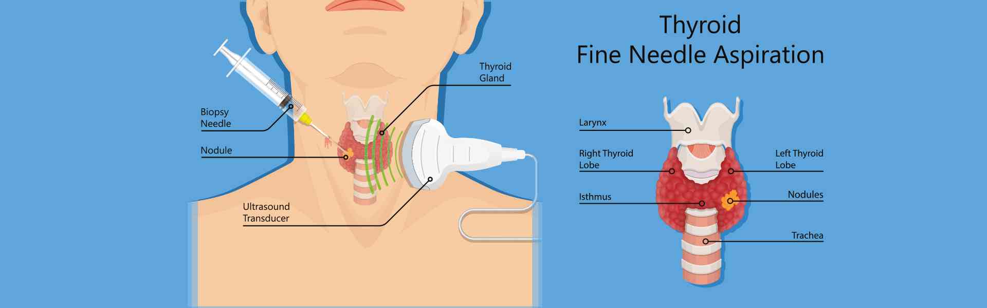 FNAC Procedure in Jayanagar