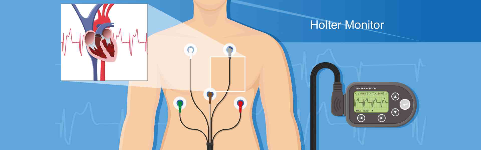 Holter Monitor Test Bangalore