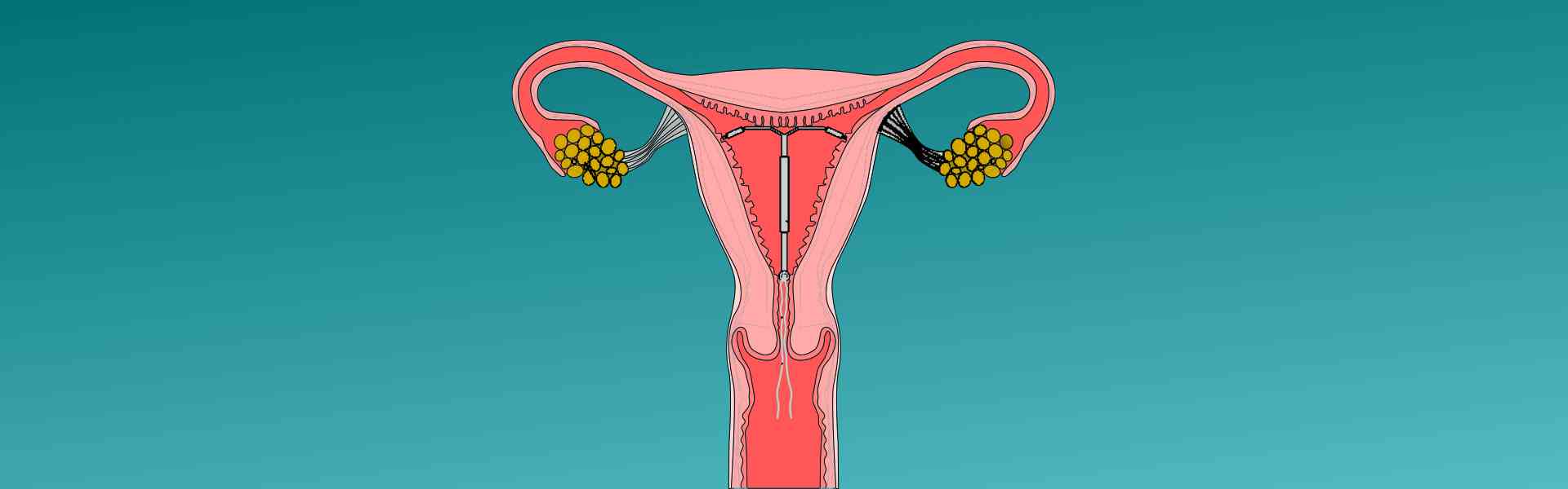 IUCD Insertion - obstetrics-and-gynaecology - Jayanagar