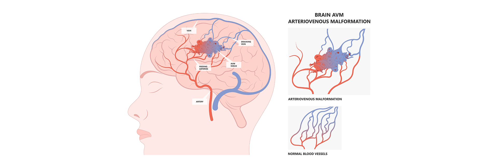 Arteriovenous Malformation (AVM) Surgery in Kanakapura Road | Manipal Hospitals