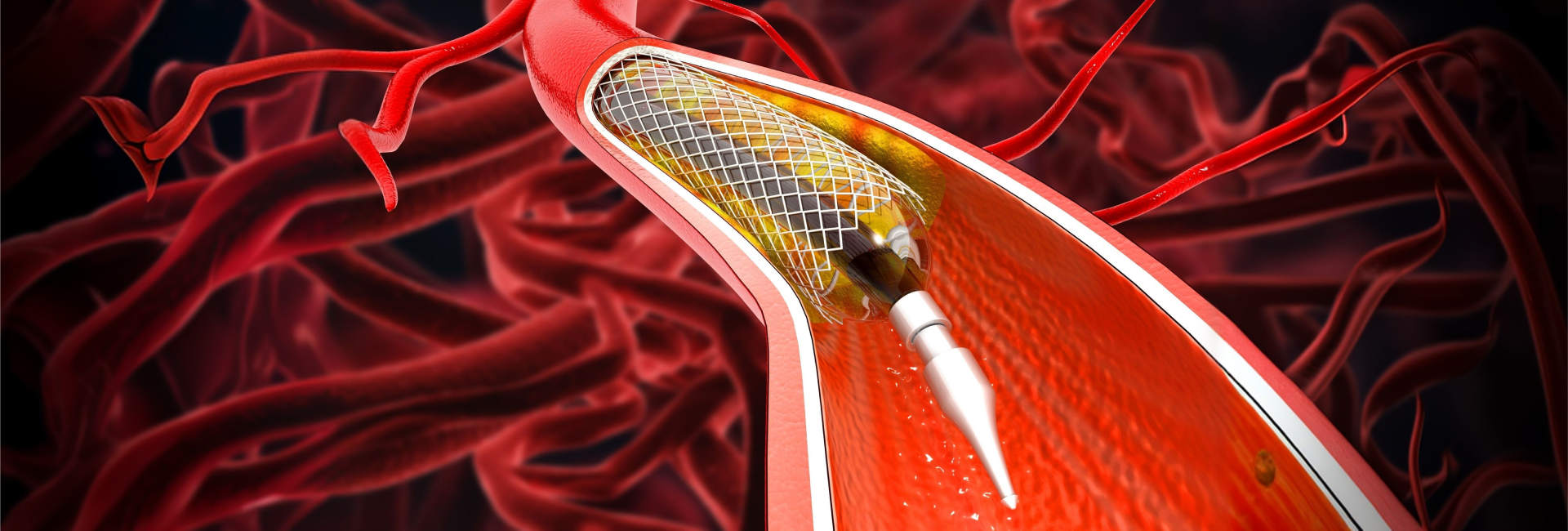 Carotid Artery Stenting in Kanakapura Road, Bangalore | Manipal Hospitals