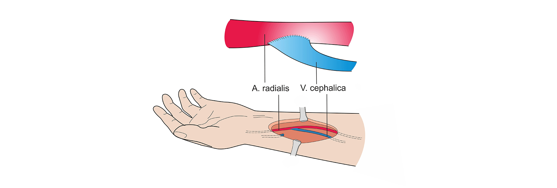 Dural Arteriovenous Fistula Treatment in Kanakapura Road | Manipal Hospitals