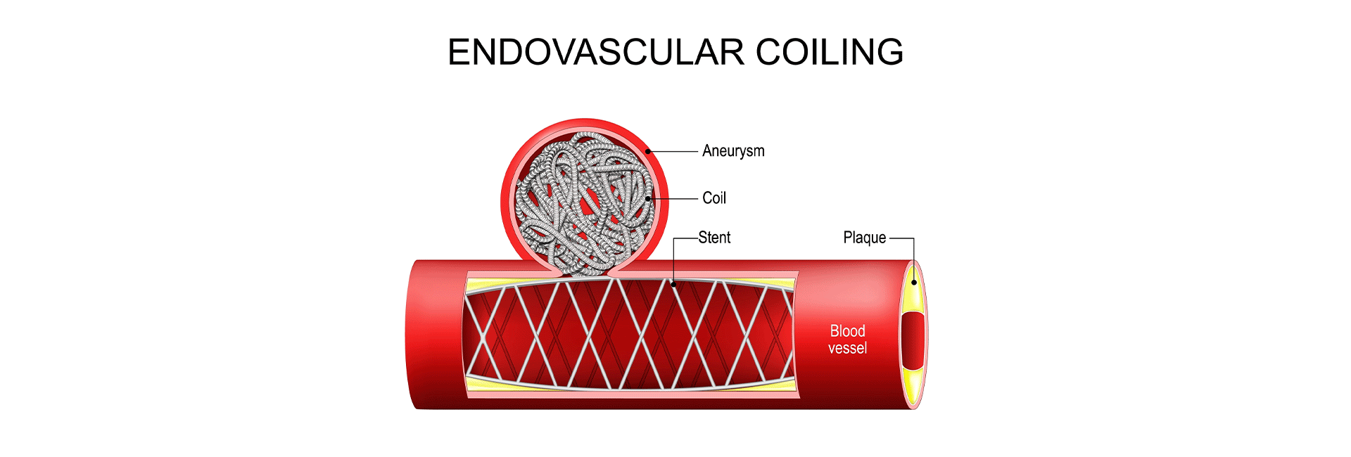 Endovascular Coiling for Brain Aneurysms in Kanakapura Road | Manipal Hospitals