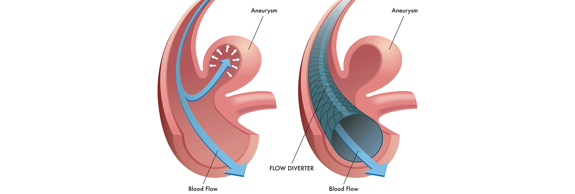 Flow Diverter Surgery in Kanakapura Road, Bangalore | Manipal Hospitals