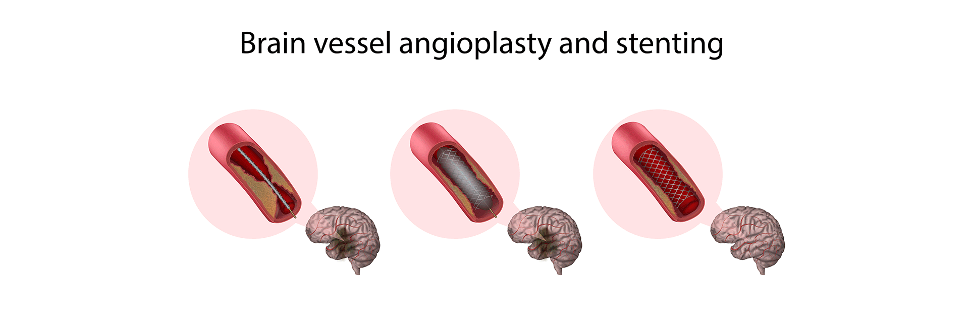 Intracranial Stenting Procedure in Kanakapura Road | Manipal Hospitals