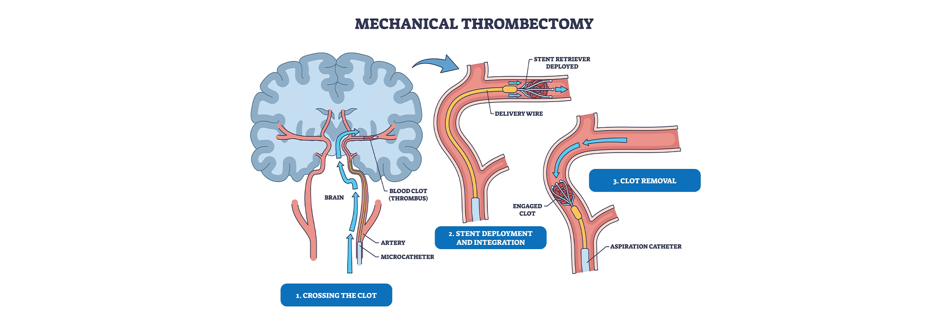 Mechanical Thrombectomy Procedure in Kanakapura Road | Manipal Hospitals