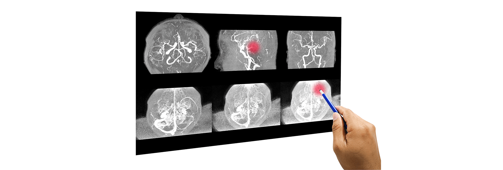 Preoperative Tumour Embolisation in Kanakapura Road | Manipal Hospitals