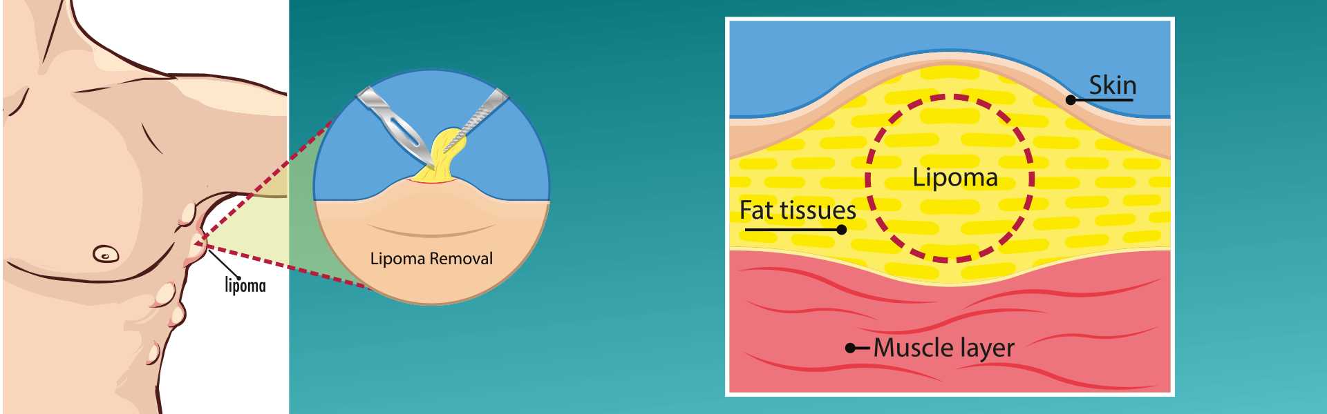 Lipoma Excision Treatment Hospital in Kharadi, Pune