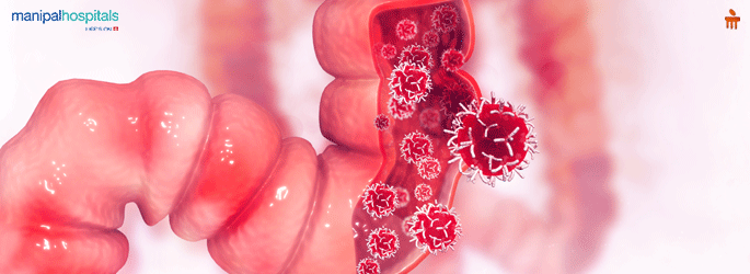 Colon Cancer Treatment in Malleshwaram Bangalore