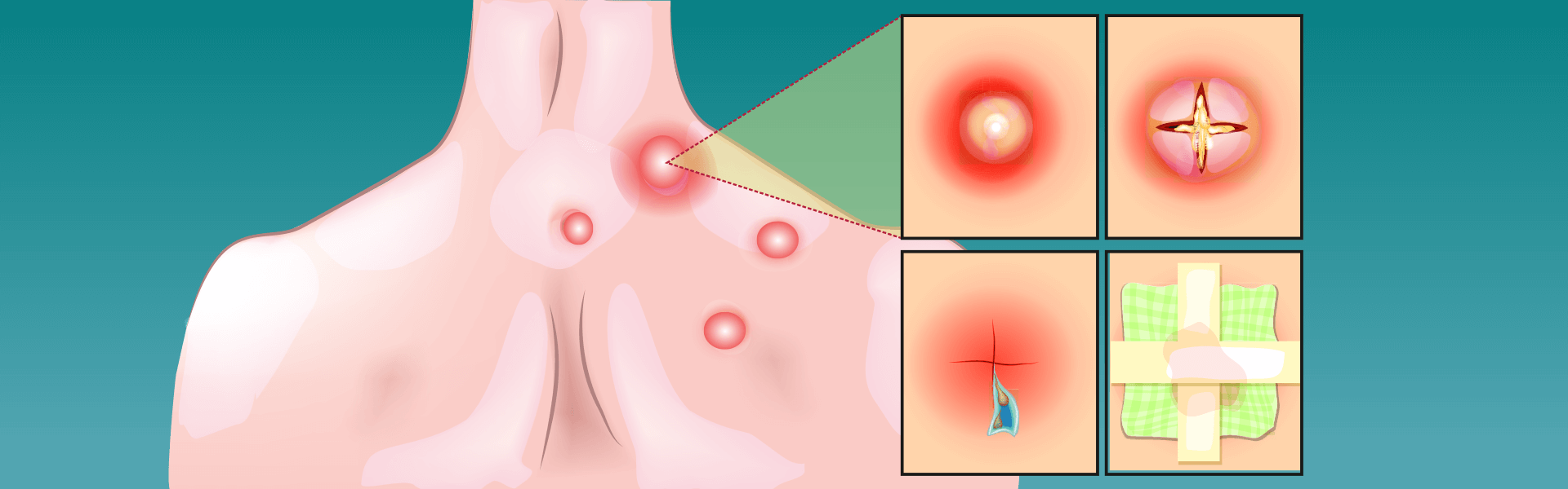 General Surgery - Skin Abscess - Manipal Hospitals Malleshwaram