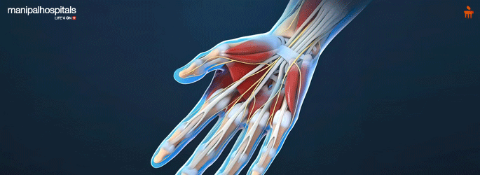Carpal Tunnel Syndrome treatment in Mangalore