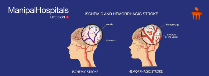 best neuro hospital in Mangalore