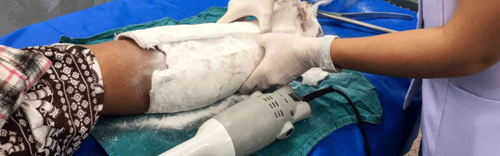 Cast Removal treatment in Mangalore 