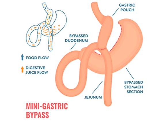 Bariatric surgery in Bangalore 