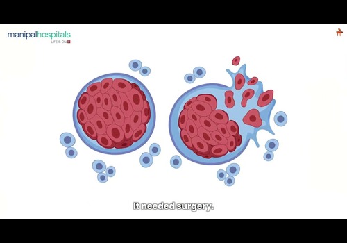Endoscopic Skull Base Surgery | Dr. Sampath Chandra Prasad Rao | Manipal Old Airport Road