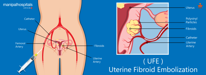 Abnormal Uterine Bleeding Treatment