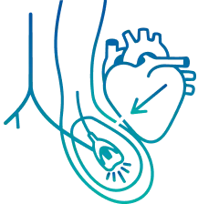 TAVR in Mysore | Manipal Hospitals